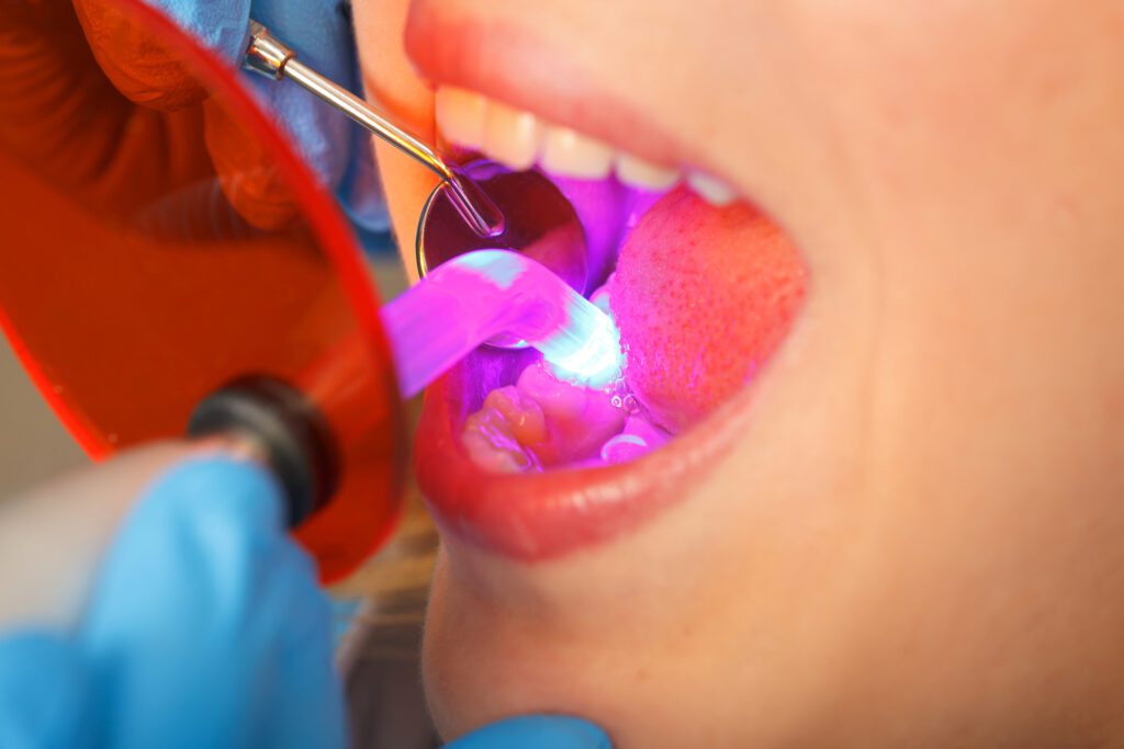 Teeth Bonding in Garland TX